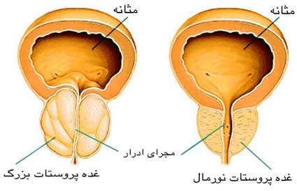 سرطان پروستات