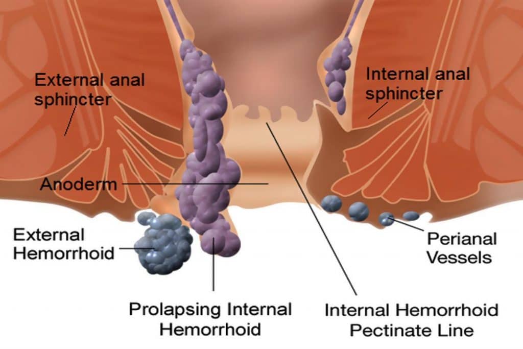 هموروئید
