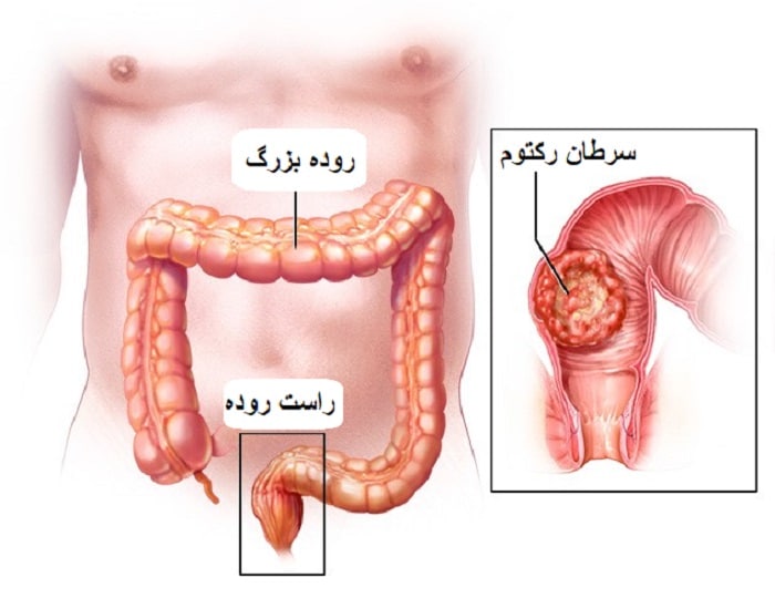 سرطان رکتوم یا راست روده