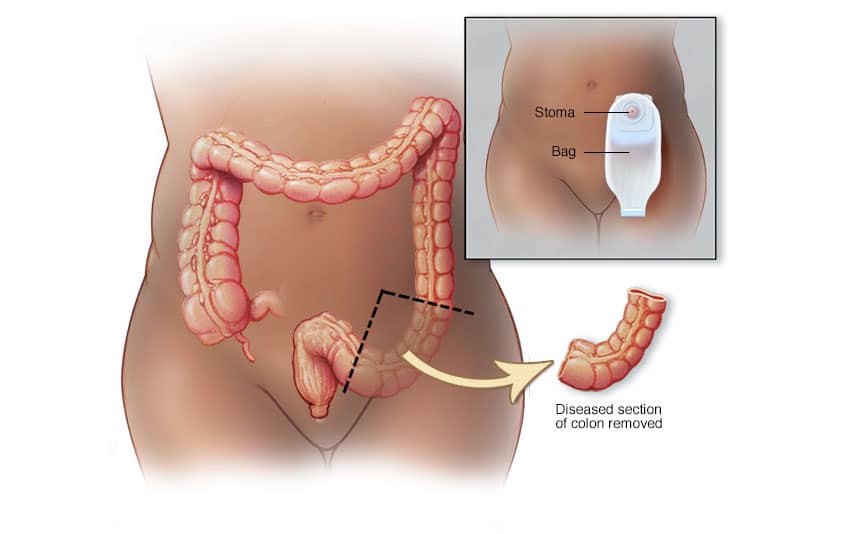 نیاز به استومی در سرطان های کولون و رکتوم