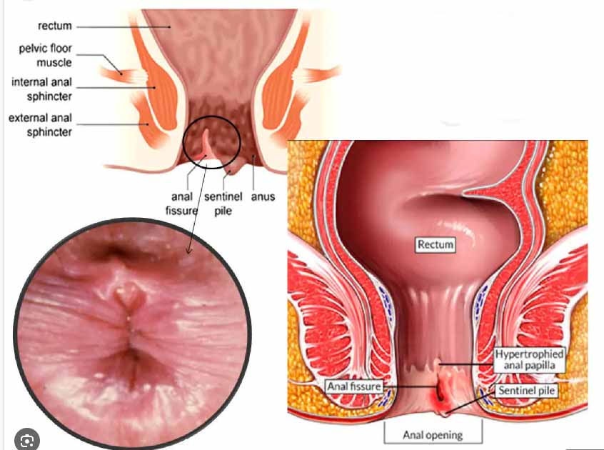 نمایش فیشر یا شقاق